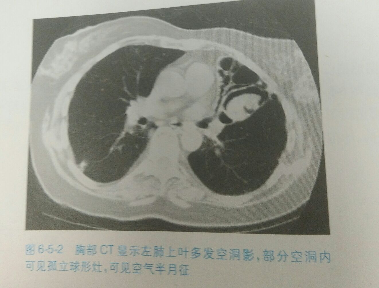 X射线肺炎图像的检测（Detecting Pneumonia in X-Ray Image）_使用深度学习算法对医疗图像如x-ray或ct扫描进行自动化分析期末报告-CSDN博客