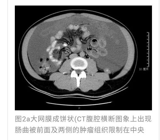 一例误诊为结核性腹膜炎的腹膜假粘液腺瘤反思