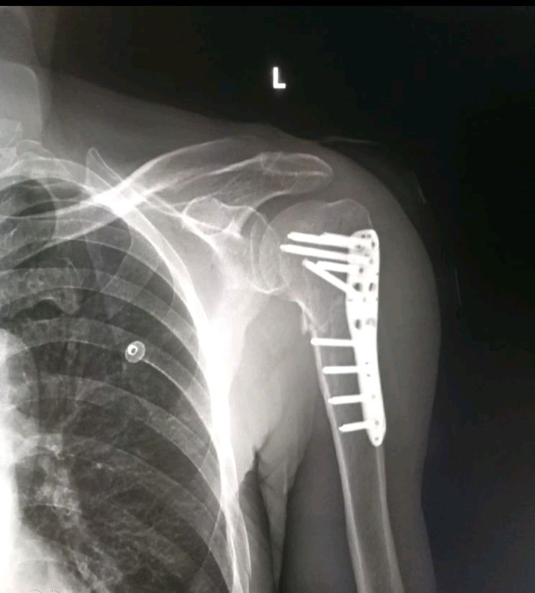 病例11 肱骨外科颈骨折(裂纹型)-特种医学-医学
