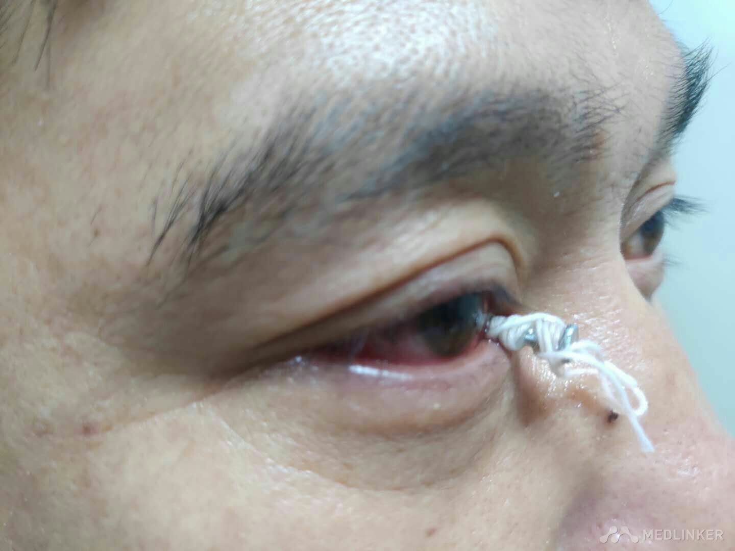 右眼球异物眼球穿通伤