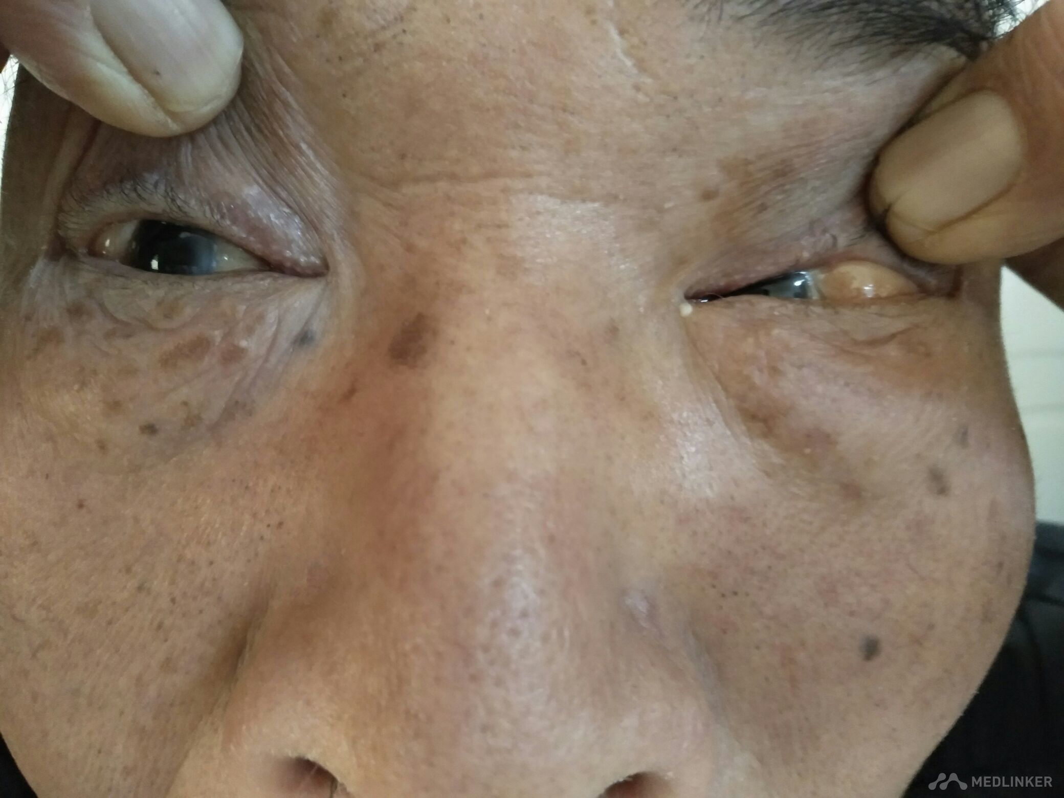 双眼眶脂肪脱垂脂肪瘤