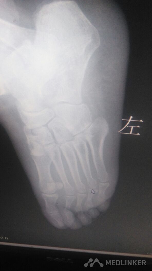 左侧足内侧楔骨骨折 医联