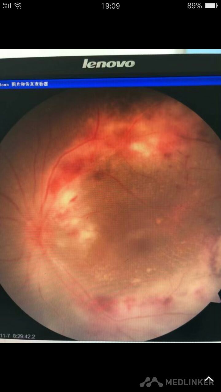 左眼梅毒性视网膜炎一例