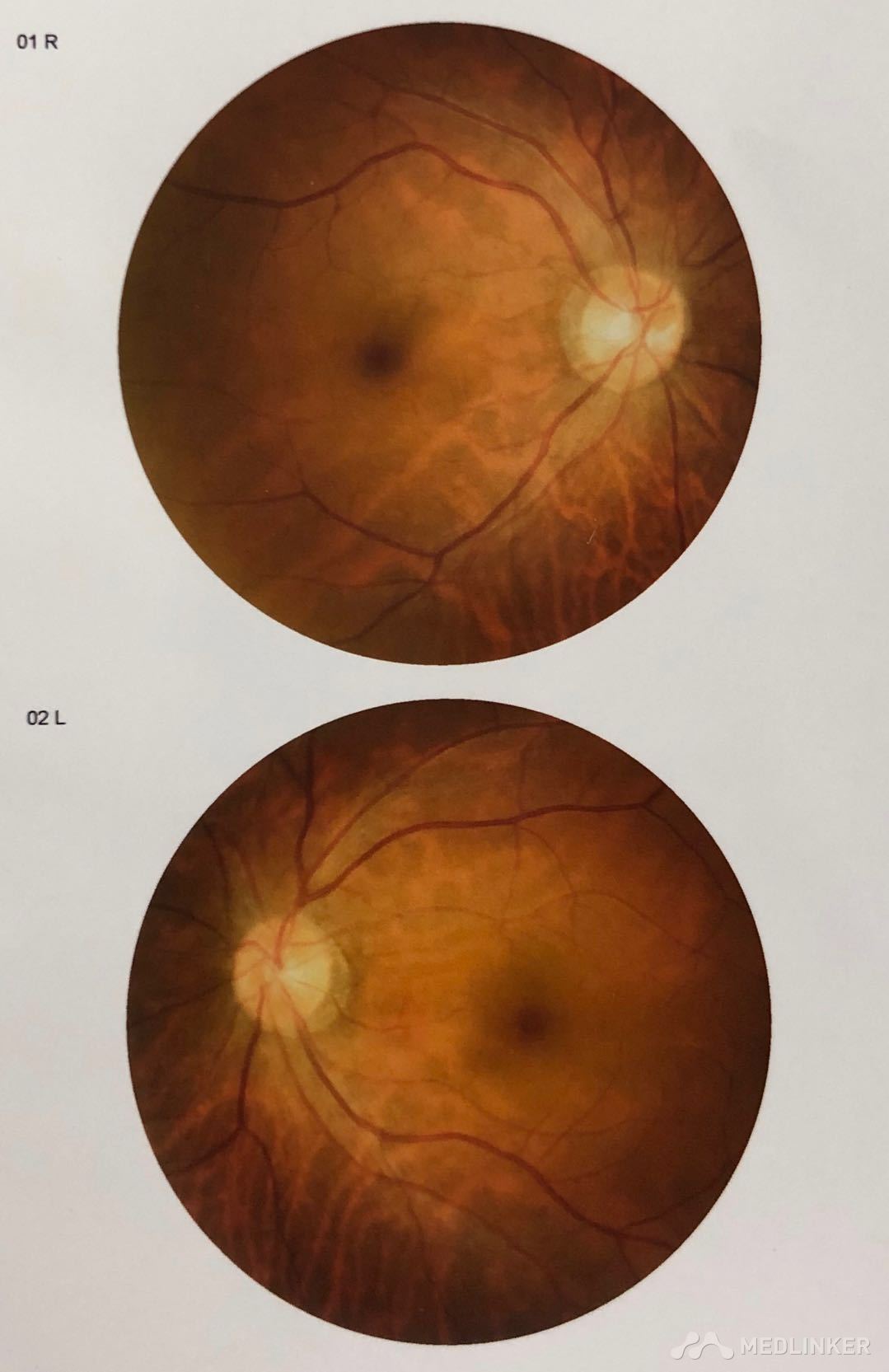 查体:视力:vod:0.8,vos:0.5(矫正视力).左眼下睑皮下淤血.