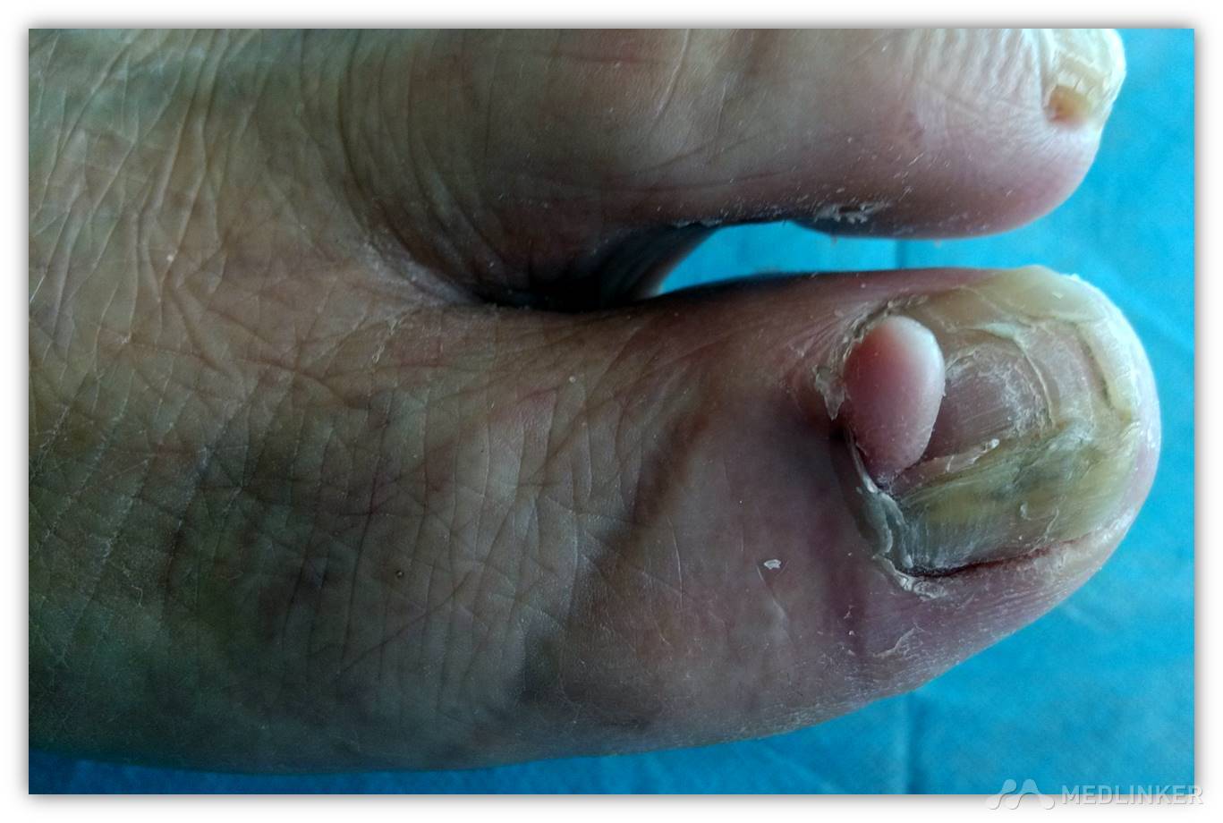 获得性甲周纤维角化瘤