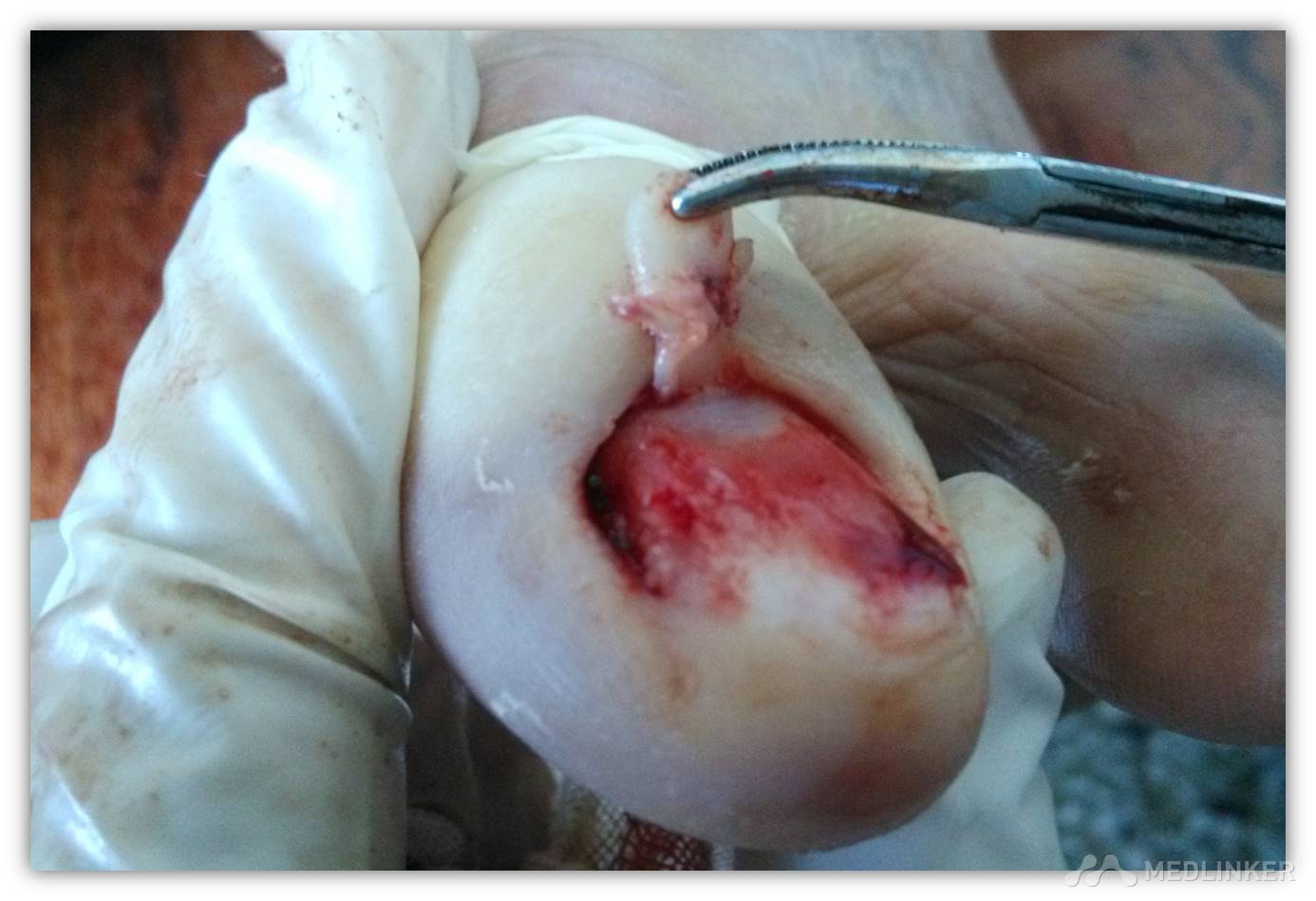 获得性甲周纤维角化瘤