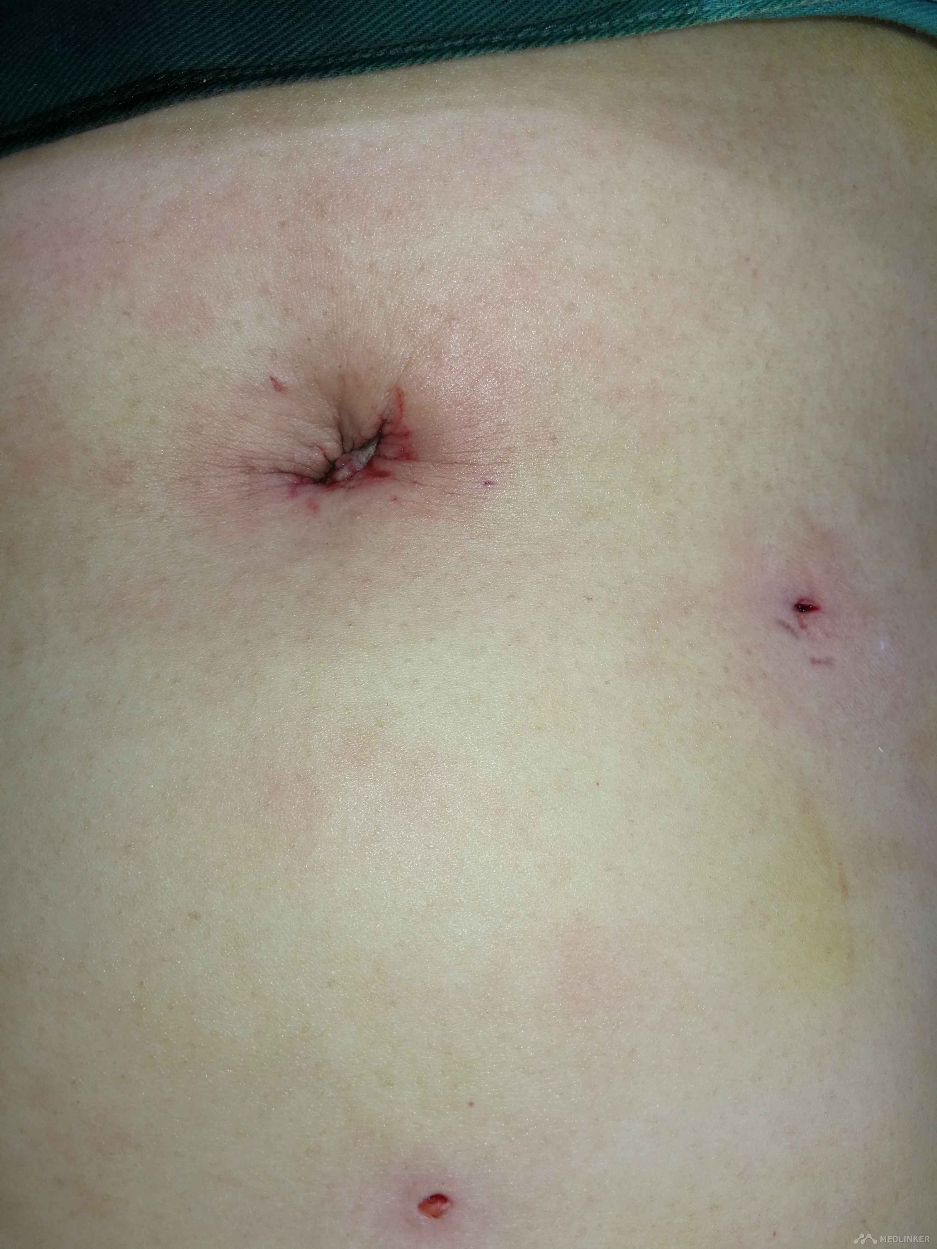 针孔腹腔镜保胆取石术