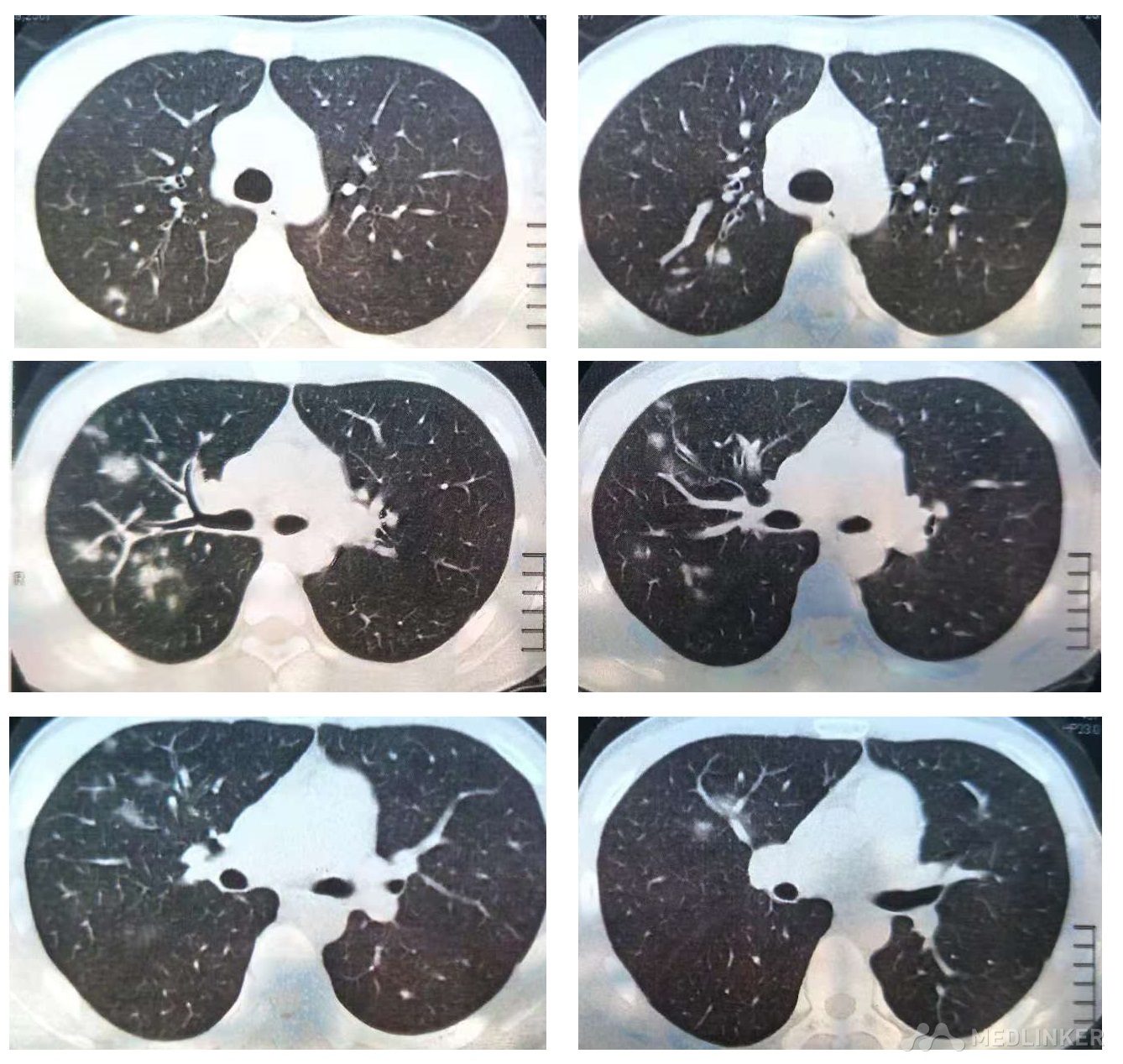 一眼就认出你是支原体肺炎而不是肺结核