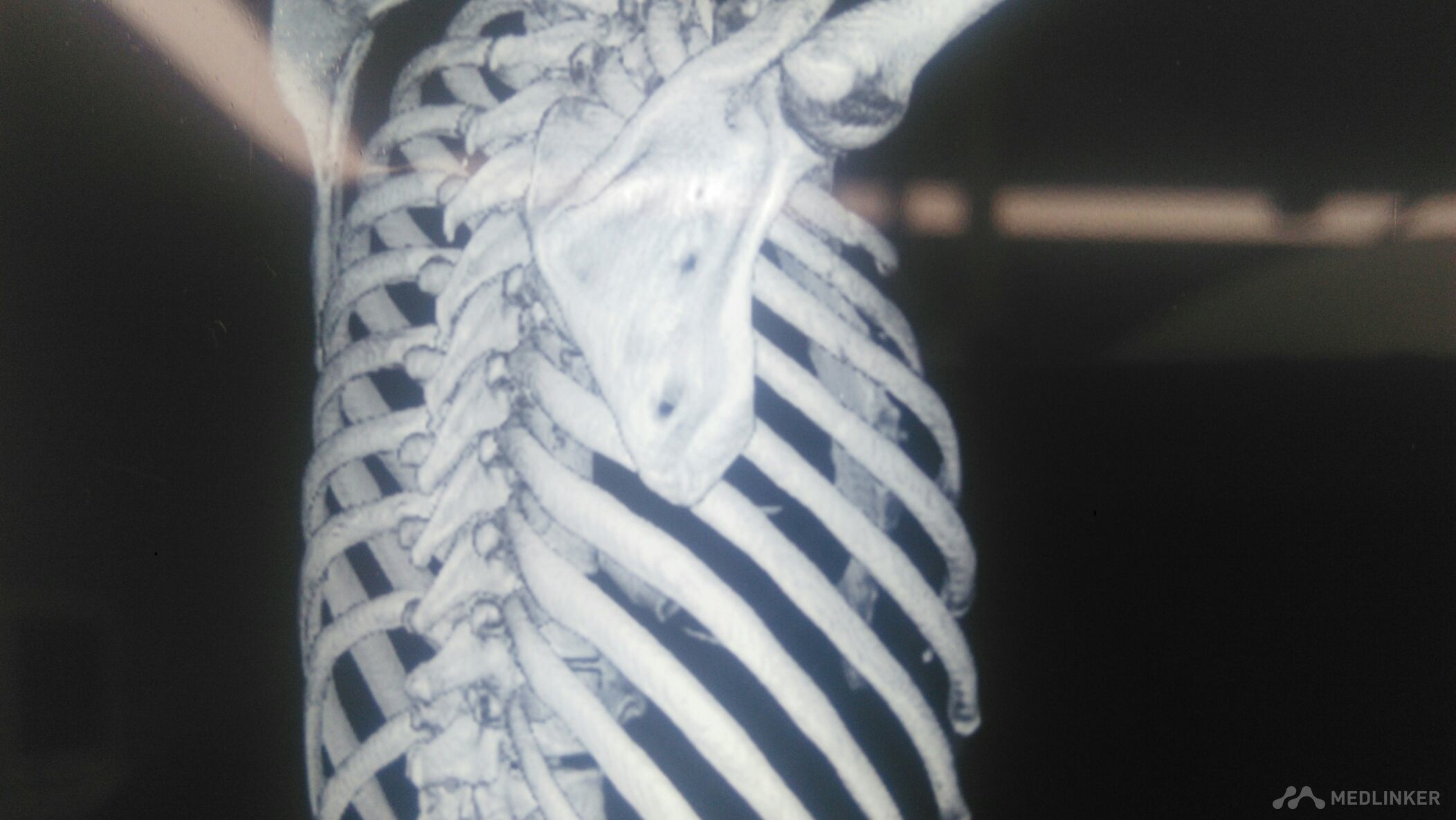 肋骨骨折断端重叠（详见CT报告单、图片）._百度知道