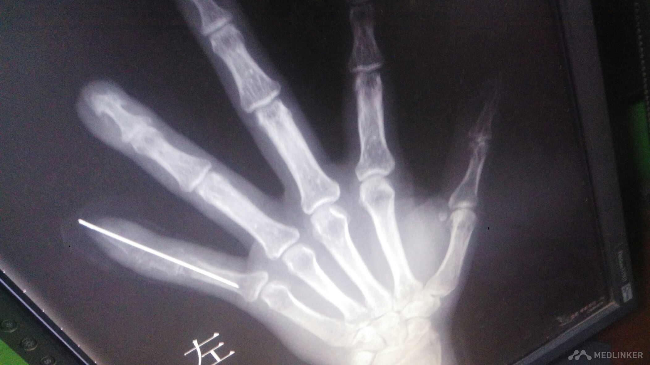 手指骨骨折 手术不好做 医联
